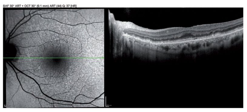 Eyerisk image lipid review 2018 05 07