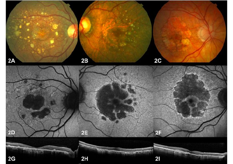 Figure 1 Classification of geographic atrophy subtypes