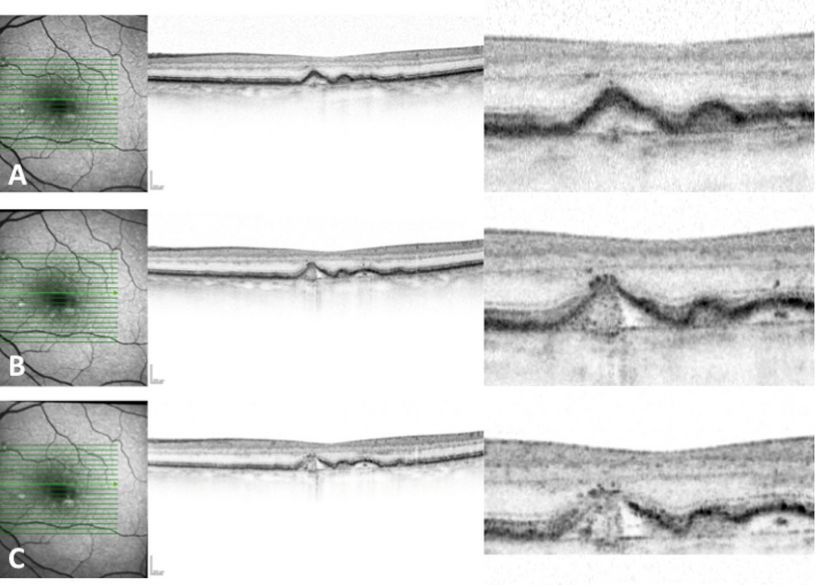 Figure 3 - A new hypothesis on the progression to geographic atrophy