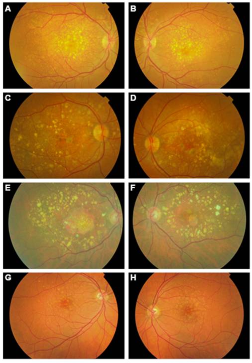 Figure 1. Color fundus photographs of carriers of rare variants in the CFH gene.