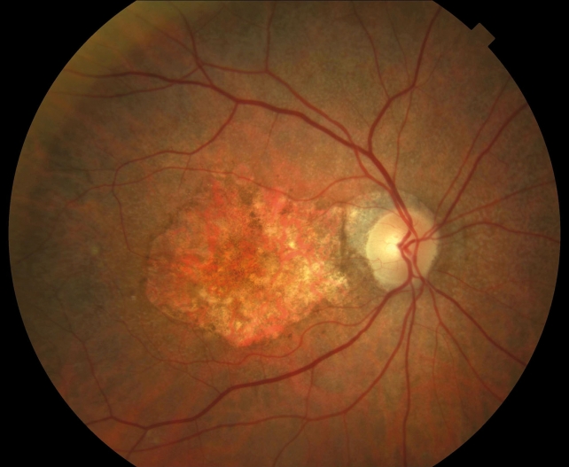 A new hypothesis on the progression to geographic atrophy