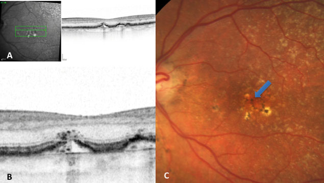 Figure 2 - A new hypothesis on the progression to geographic atrophy